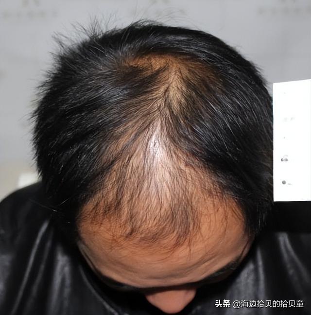 好?育发液什么牌子最有效果?新葡京日本生发液哪个牌子最(图4) 好?育发液什么牌子最有效果?新葡京日本生发液哪个牌子最(图4)